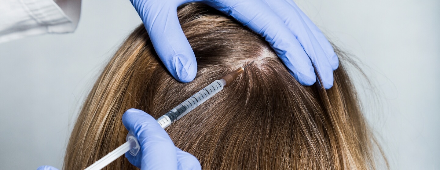 Causes of Alopecia in Females – Should you be Afraid?