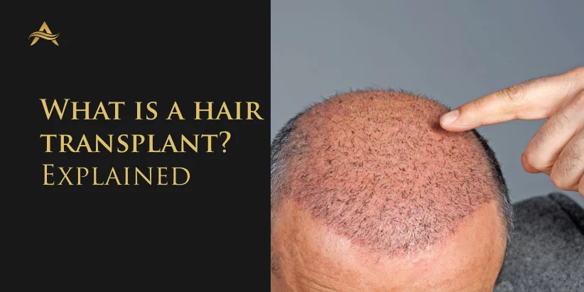 What is a Hair transplant and should you opt one?