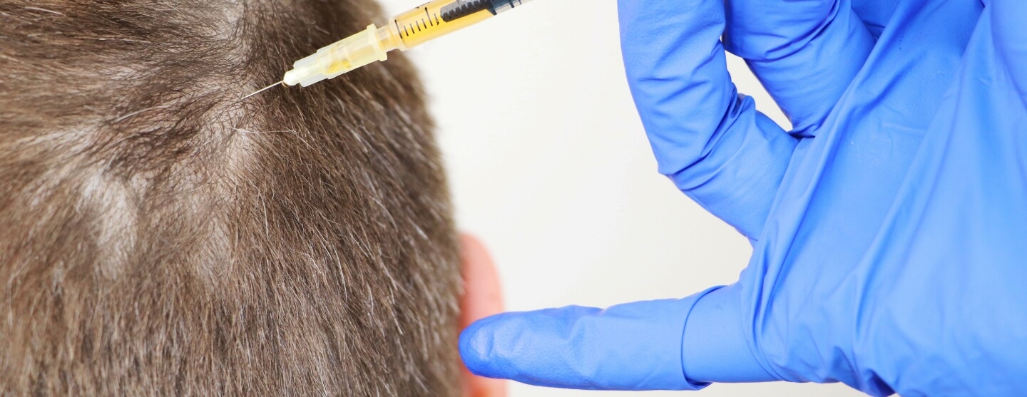 Using hair transplants to camouflage scars – Is It effective?