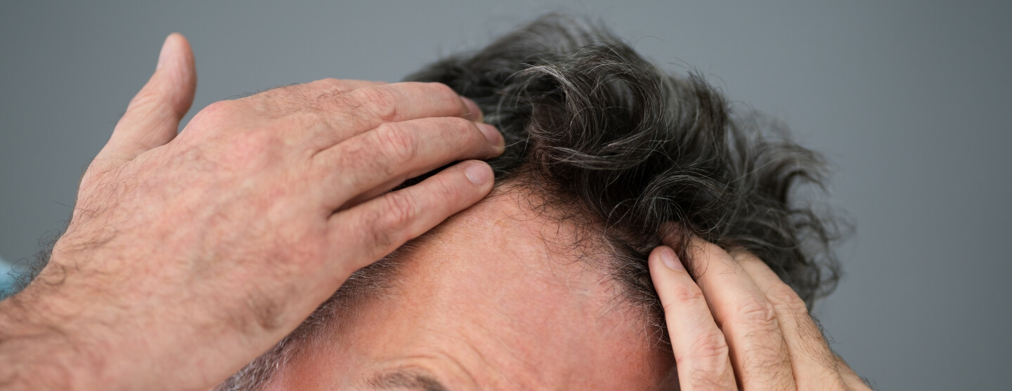 Stemoxydene As A Treatment For Hair Loss
