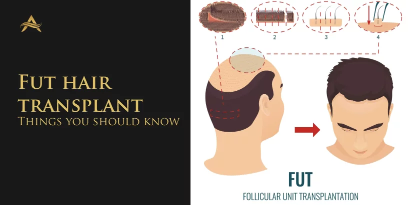 What are the Advantages and Disadvantages of Hair Transplant? - AHS India