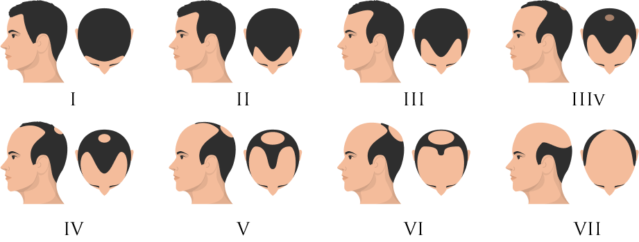 Male Hair Loss