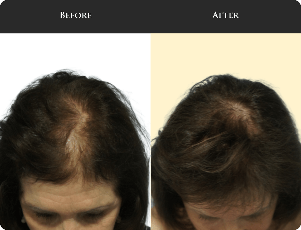 CRP Hair Loss Treatment