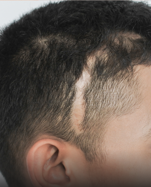 Low Level Laser Therapy Treatment for Hair Loss