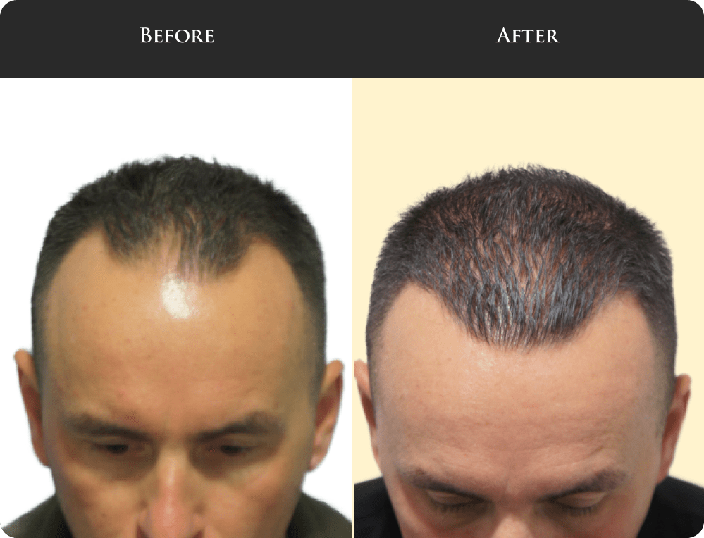 male-hair-loss-19-min