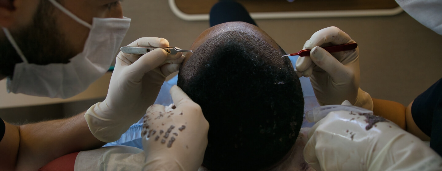 Is Hair Transplant Surgery A Good Option For Treating Hair Loss?
