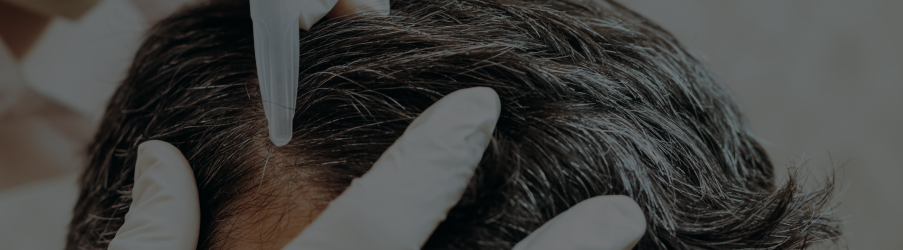 Types of Hair Transplant Techniques Which One is Right for You?