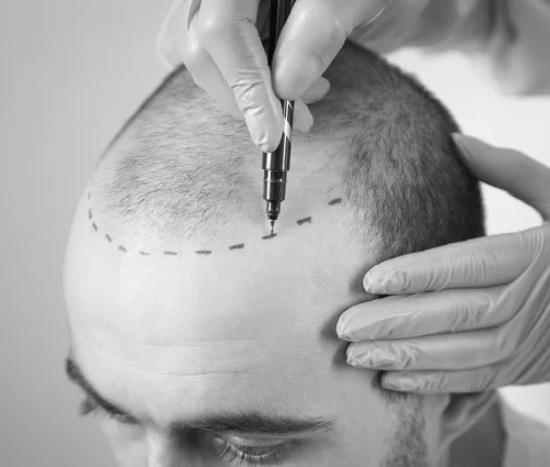 Hair Transplant Clinic in Melbourne