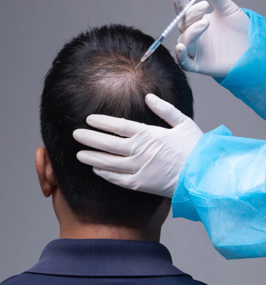 Hair Transplant Treatment in Melbourne