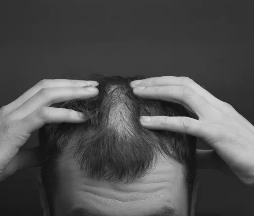 Male Hair Baldness Medication