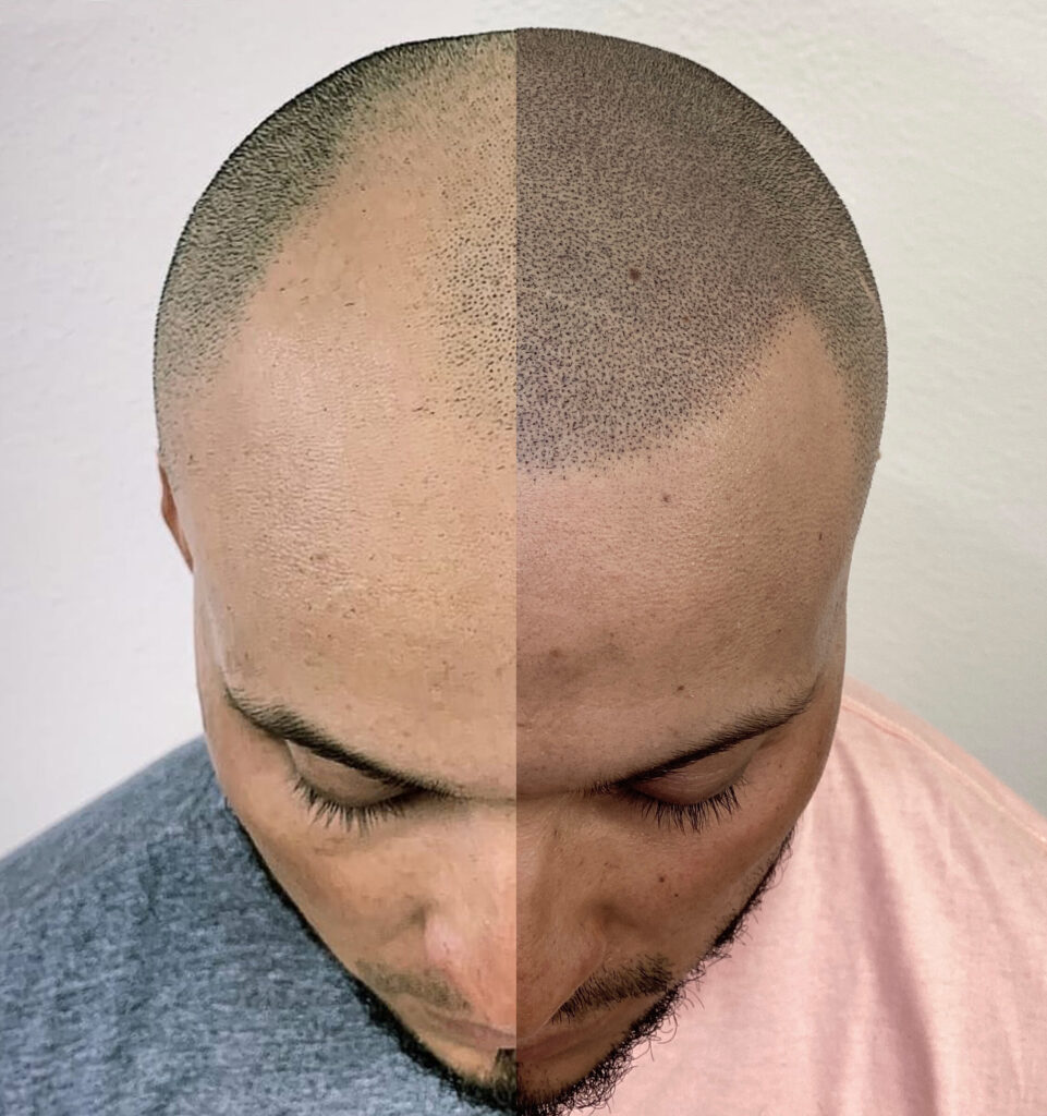 Baldness Treatment
