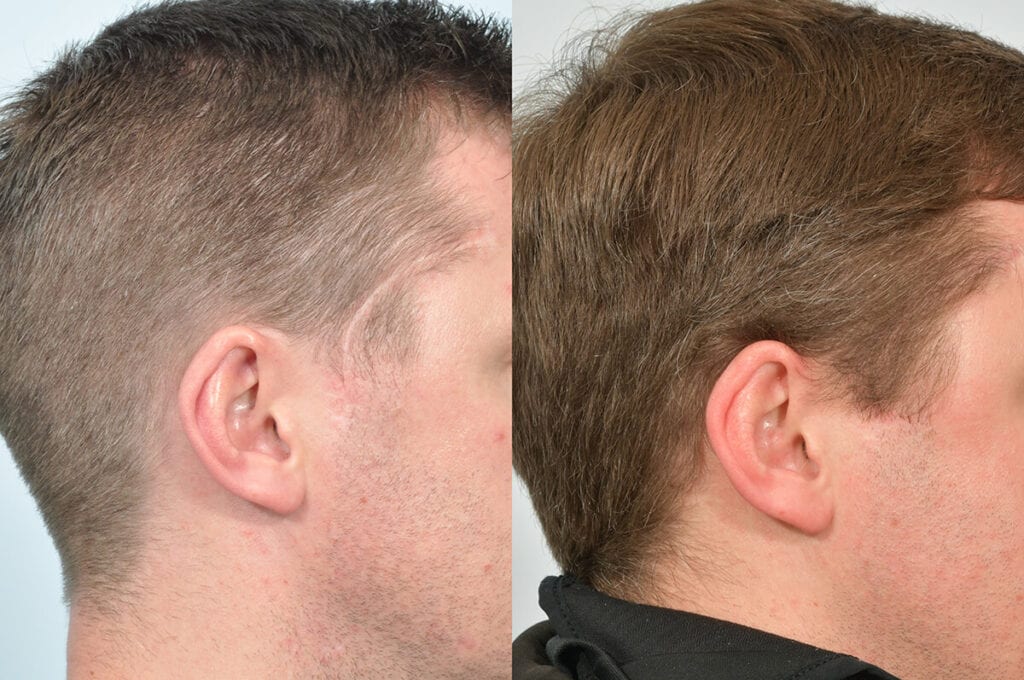 hair-restoration-scar