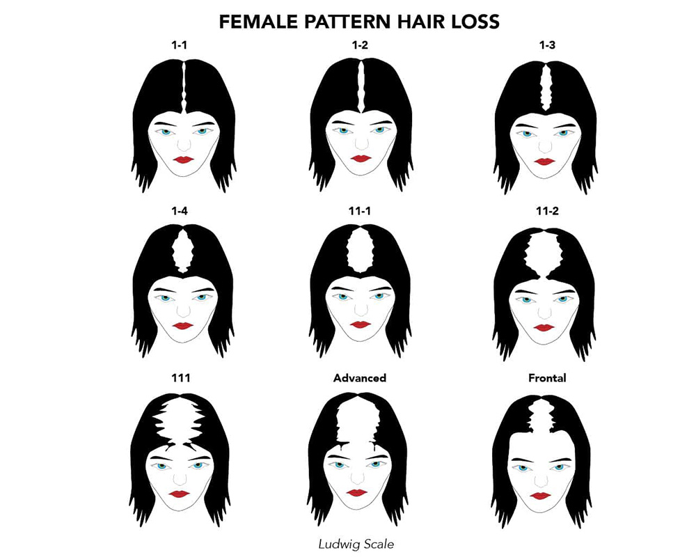 what causes hair loss in females, hair loss factors, female hair shedding