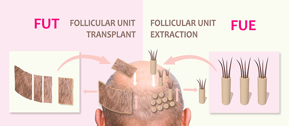 best hair transplant method, types of hair transplant, FUE and FUT explained
