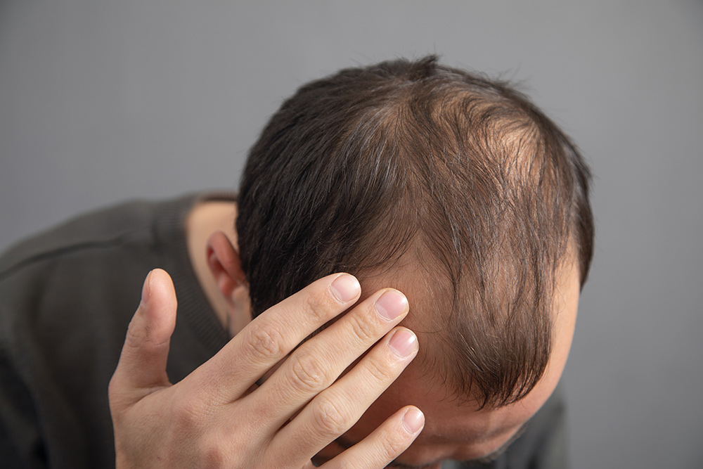 hair loss medication, fuller hair, support hair growth