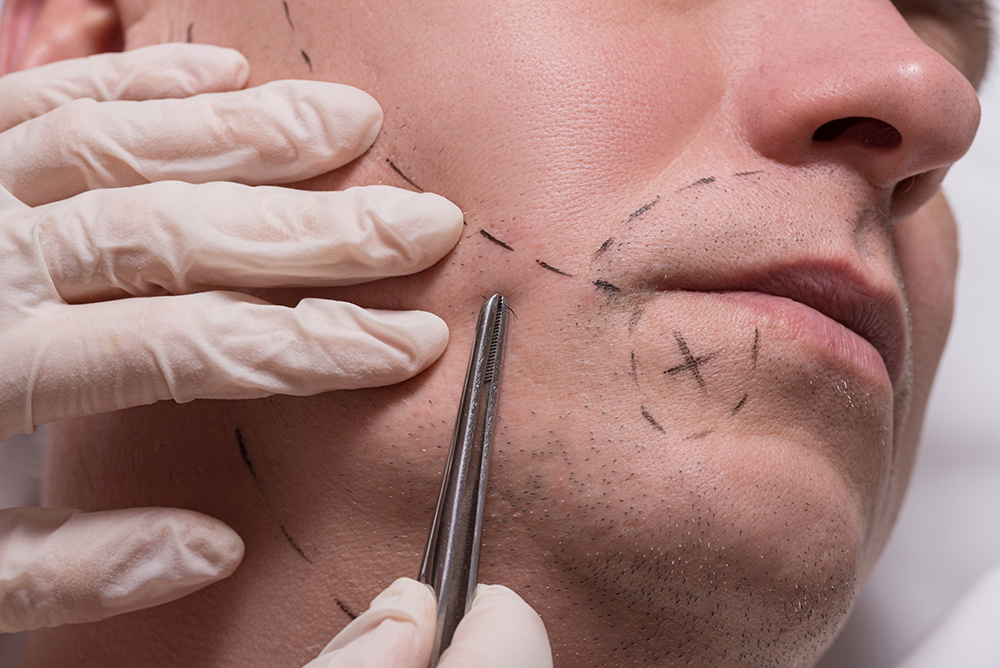 beard transplant Melbourne, FUE beard restoration, patchy beard treatment