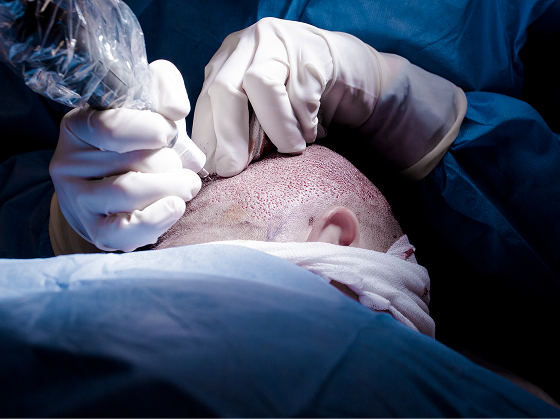 when to get a hair transplant, natural hair transplant results, hair restoration timing