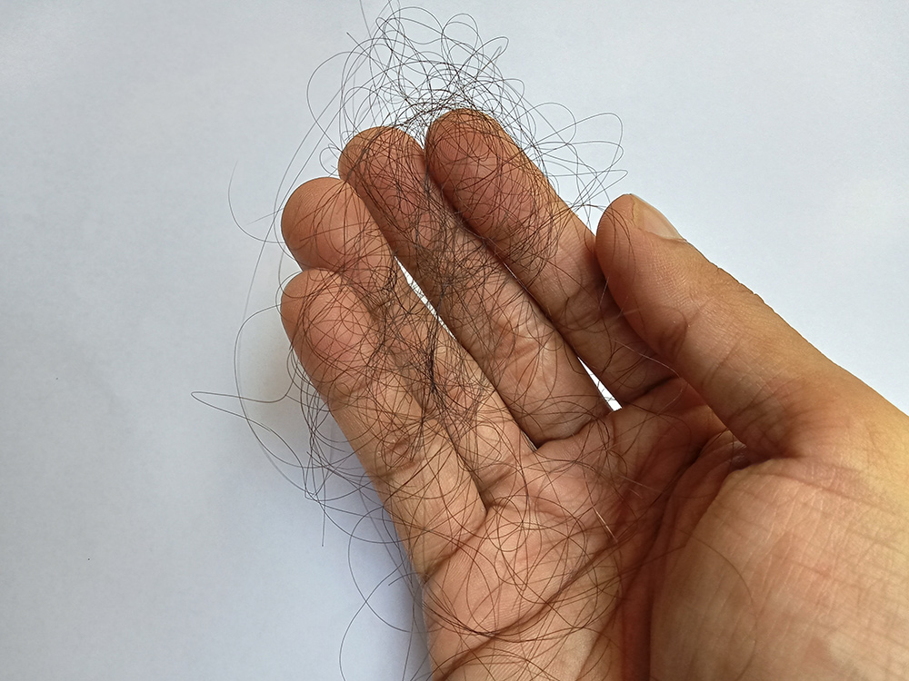 does stress cause hair loss, stress-related hair loss, hair growth cycle, hair shedding from stress