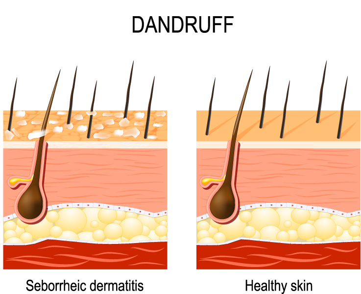 itchy scalp and hair loss, scalp irritation, hair loss causes