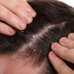 does dandruff cause hair loss dandruff and hair loss dandruff causes dandruff treatment scalp health