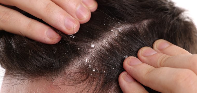 does dandruff cause hair loss dandruff and hair loss dandruff causes dandruff treatment scalp health