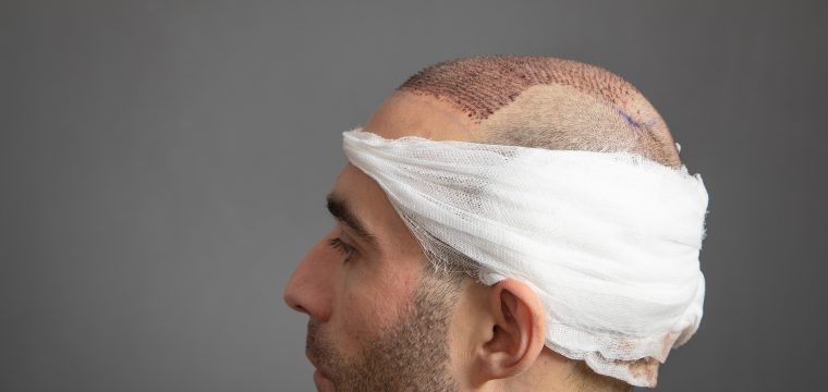 how long does a hair transplant last hair transplant longevity long term hair transplant results how long do hair transplants last