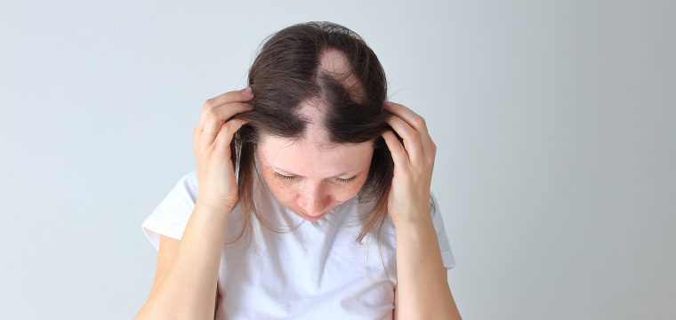 what is alopecia areata alopecia areata alopecia areata symptoms alopecia areata treatment