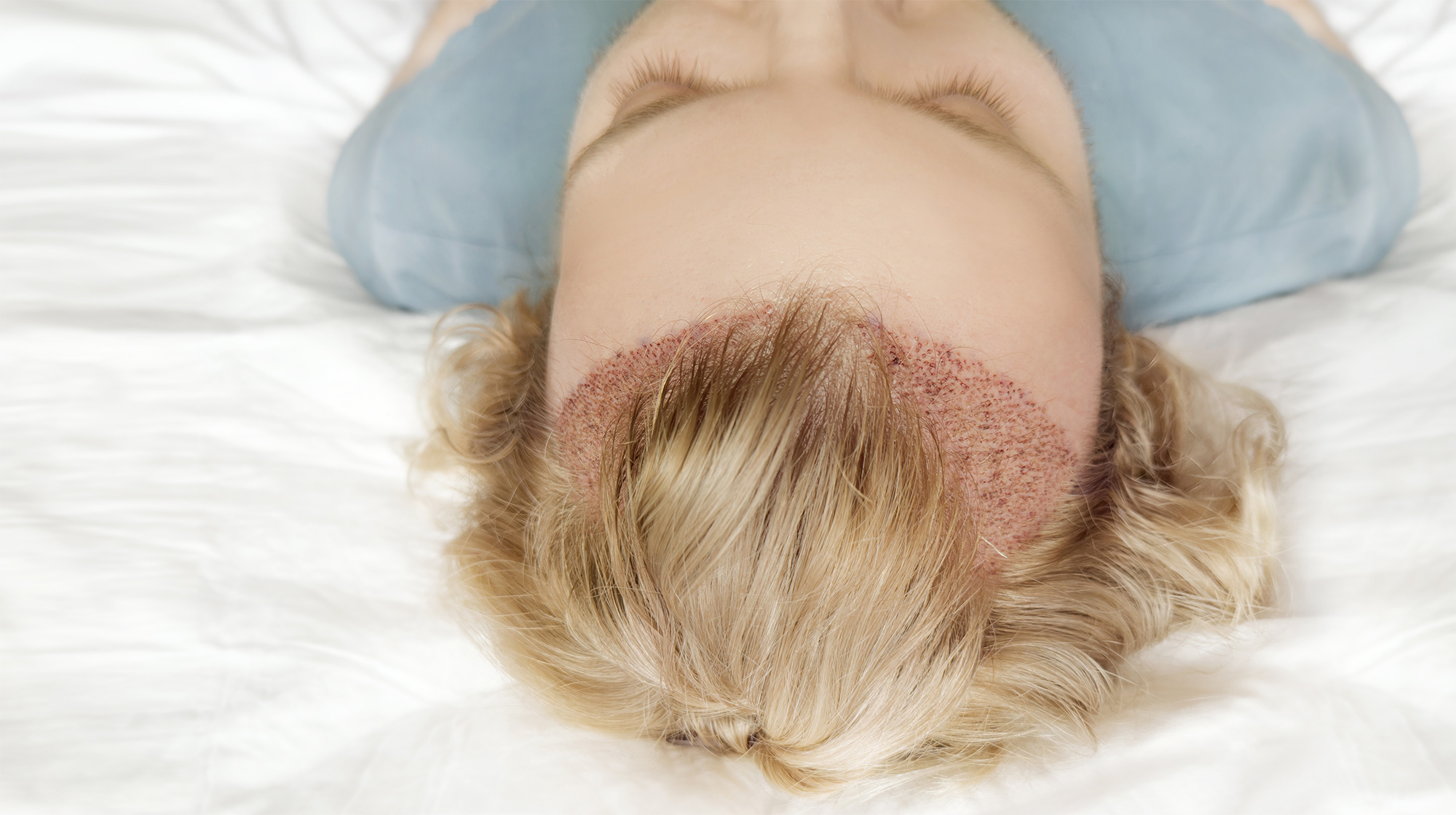 female hair transplant Melbourne