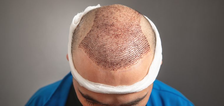 Hair transplant timeline Hair transplant recovery timeline Hair transplant healing timeline Hair transplant healing process
