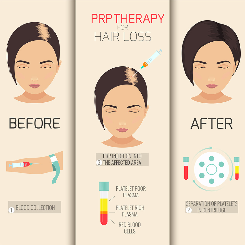 does PRP work for hair loss, growth factor therapy hair loss, follicle support treatment, non-surgical hair restoration