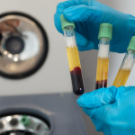 does PRP work for hair loss PRP hair restoration PRP for hair loss growth factor therapy hair loss