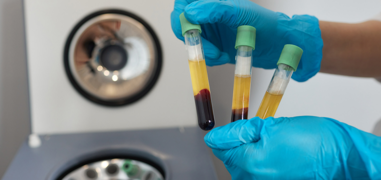 does PRP work for hair loss PRP hair restoration PRP for hair loss growth factor therapy hair loss