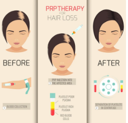 does PRP work for hair loss, growth factor therapy hair loss, follicle support treatment, non-surgical hair restoration