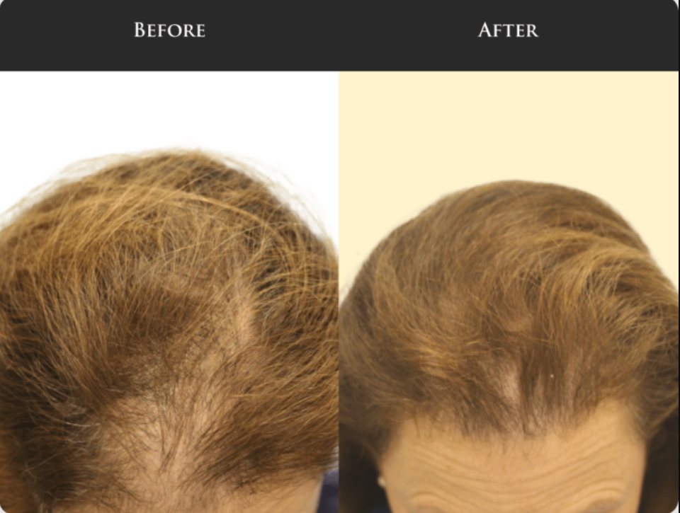 does PRP work for hair loss, long-term hair loss management, growth factor therapy plan, hair maintenance strategy