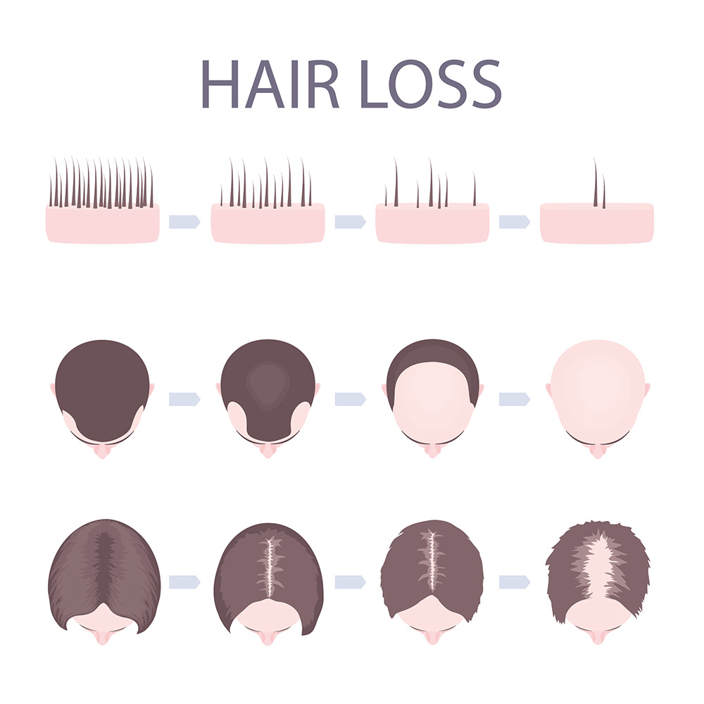 stages of hair loss, early hair thinning, hairline changes, scalp visibility