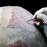 are hair transplants worth it hair transplant success rate hair transplant results worth it