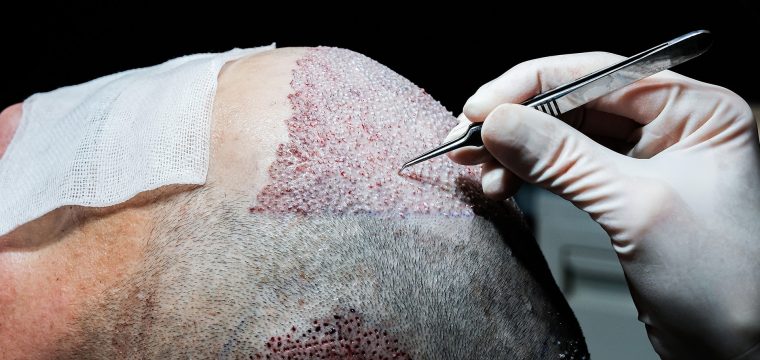 are hair transplants worth it hair transplant success rate hair transplant results worth it