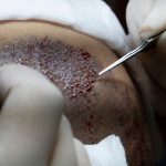 what is FUE hair transplant FUE hair transplant cost FUE hair transplant recovery