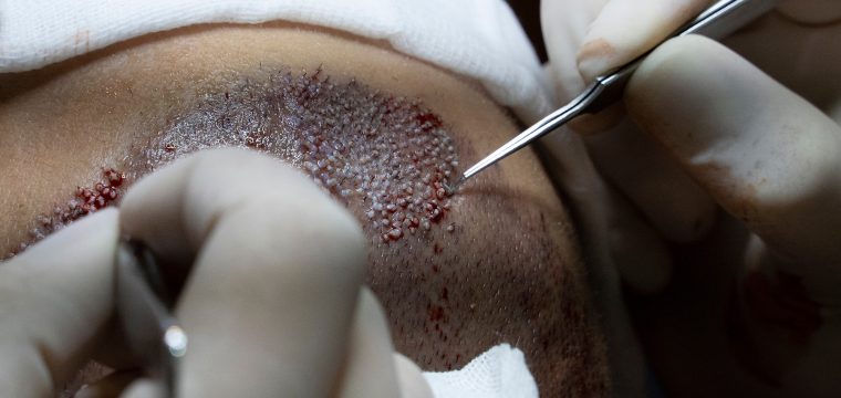 what is FUE hair transplant FUE hair transplant cost FUE hair transplant recovery