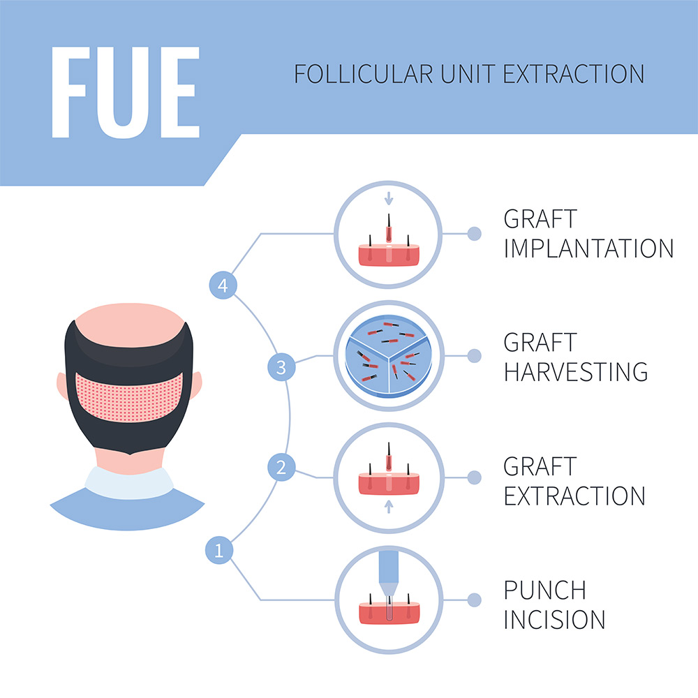 what is FUE hair transplant, FUE hair transplant procedure, hair follicle extraction, hair restoration treatment