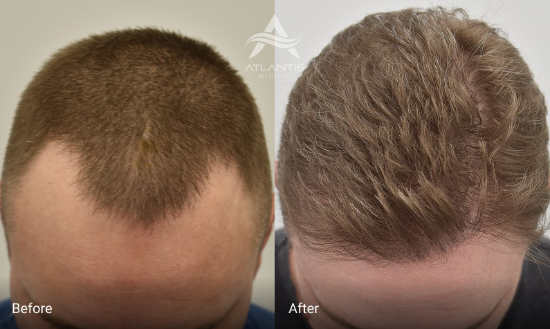what is FUE hair transplant, FUE hair transplant results timeline, hair transplant growth stages, FUE hair growth