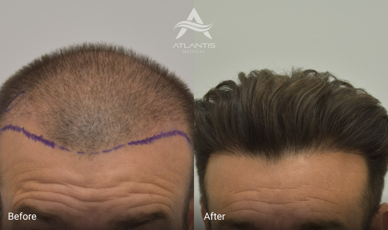are hair transplants worth it, hair transplant thinning areas, hair transplant density, hair transplant results