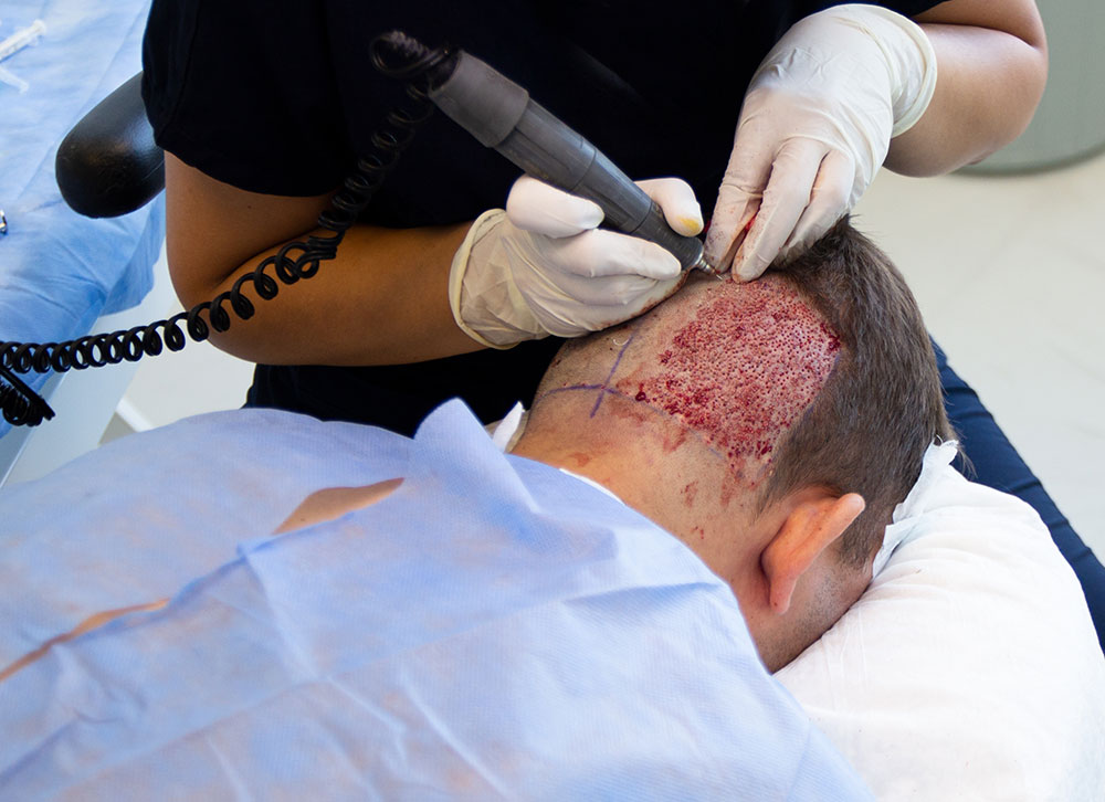 what happens during a hair transplant, hair transplant procedure, scalp preparation