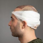 what happens to the donor area after FUE, FUE donor area healing, FUE extraction sites, donor area care