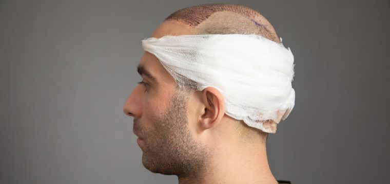what happens to the donor area after FUE, FUE donor area healing, FUE extraction sites, donor area care