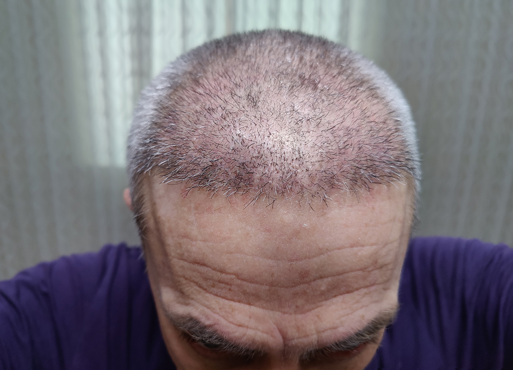 what happens to the donor area after FUE, donor area care, FUE donor area recovery